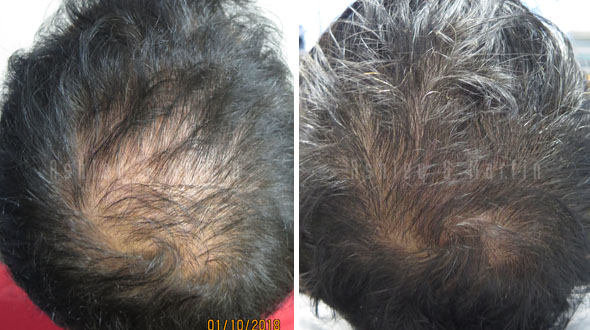 Results reducing the visibility of bald spots