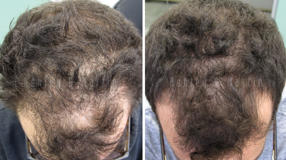 Hair Loss Came as No Surprise. But Regrowth was Shocking Image