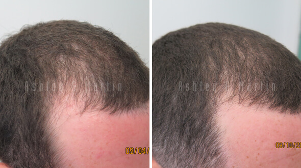 Medical Hair Treatment Regrows Hair without Surgical Transplant Image
