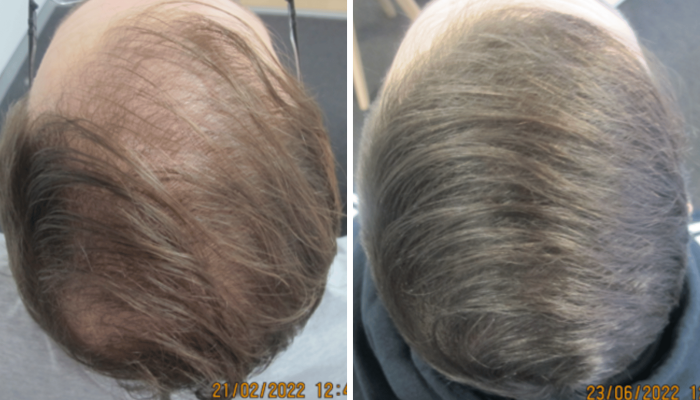 Hair regrowth results from hair loss drugs