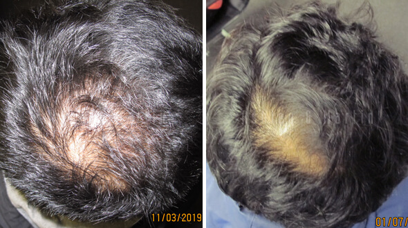 Results treating male hair loss on the top of the head