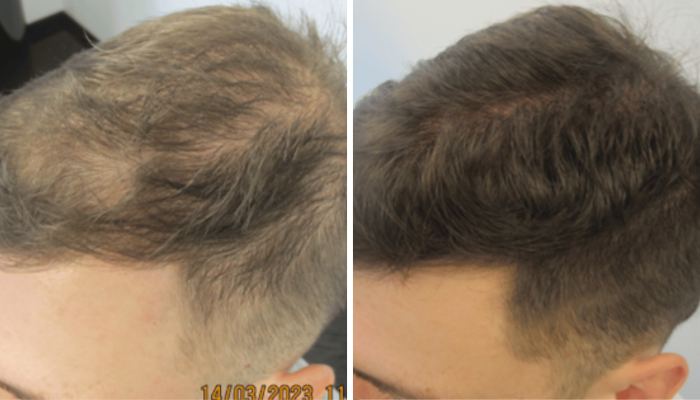 results treating male pattern baldness