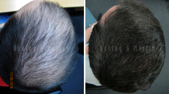 Client Confident in Using Ashley and Martin After Seeing Friend Regrow Hair Image