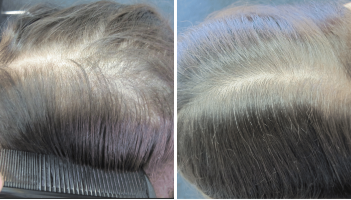 hair thinning in women hair loss treatment results 3