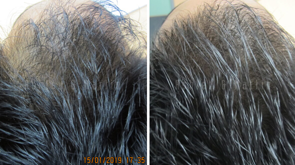 Results treating receding hairline in men