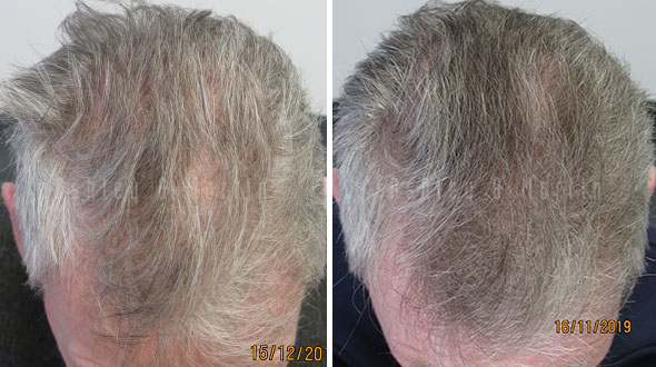 Results of laser cap hair loss treatment for older man