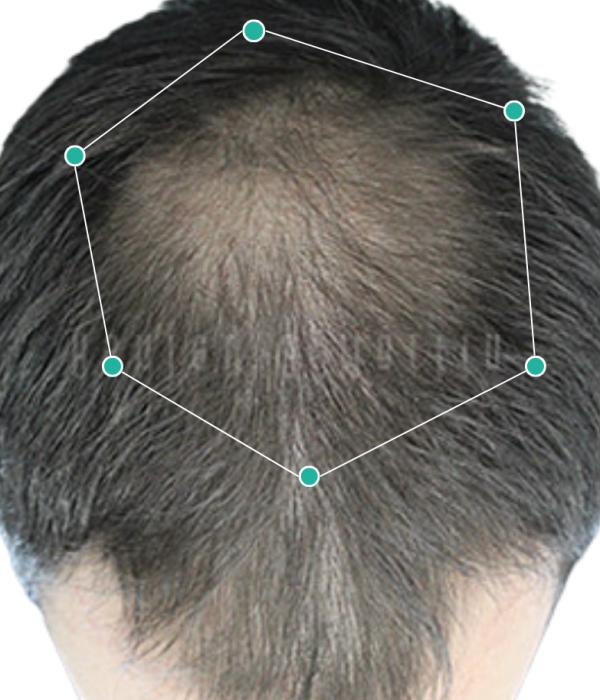 Hair loss treatment for teenage hair loss