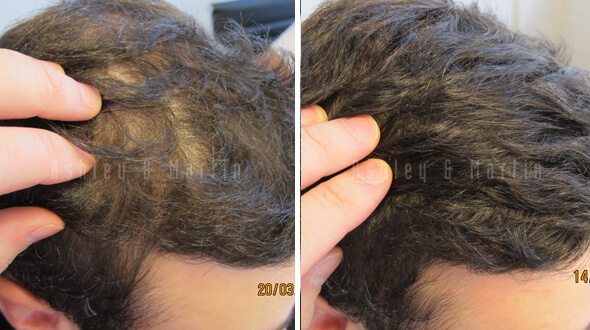 Treatment results for man with male pattern baldness