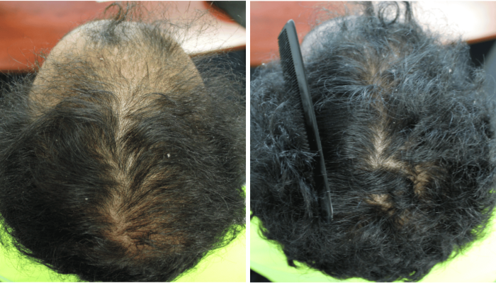 male pattern balding hair loss treatment results 3
