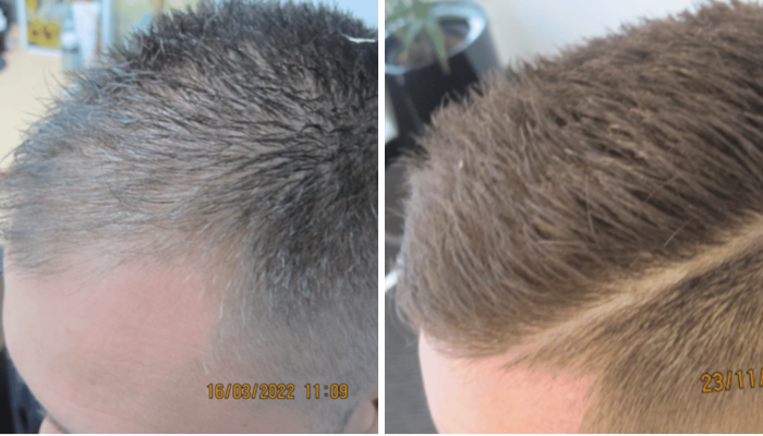 early balding hair loss treatment results