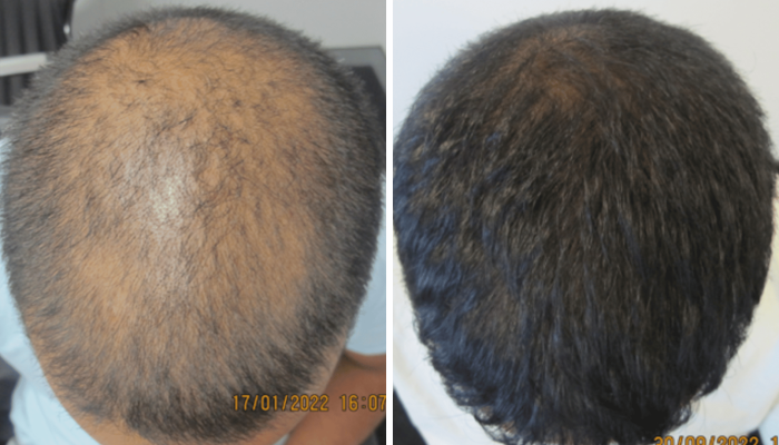 Results from a hair loss finasteride minoxidil treatment