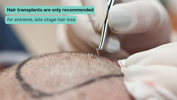 FUE hair transplants are an effective treatment for late stage hair loss
