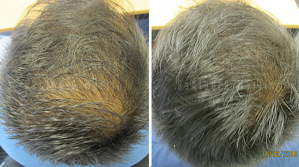 Treatment results for mens hair thinning