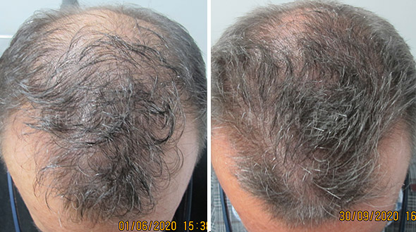 Results of a hair loss treatment for older men.