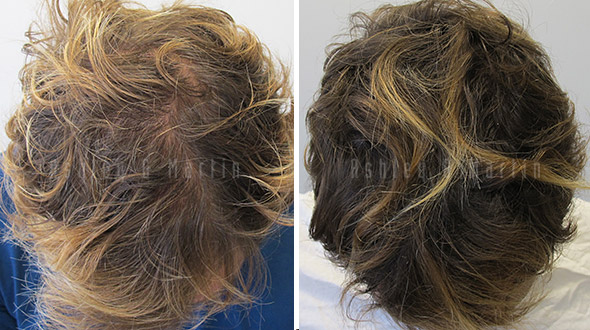 Results form a finasteride hair loss treatment