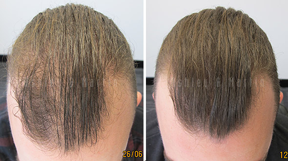 Genetic Hair Loss Treatment