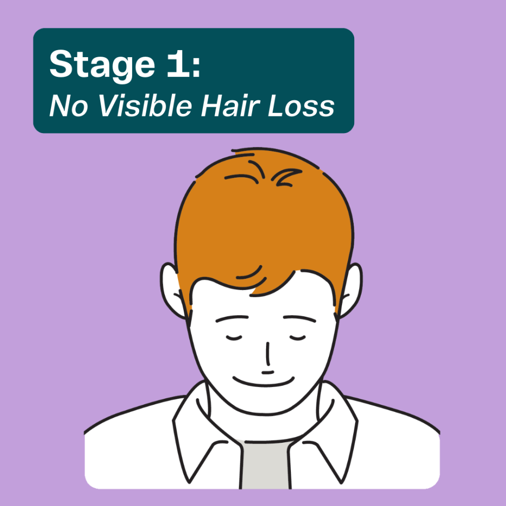 Early mens hair loss at Stage 1