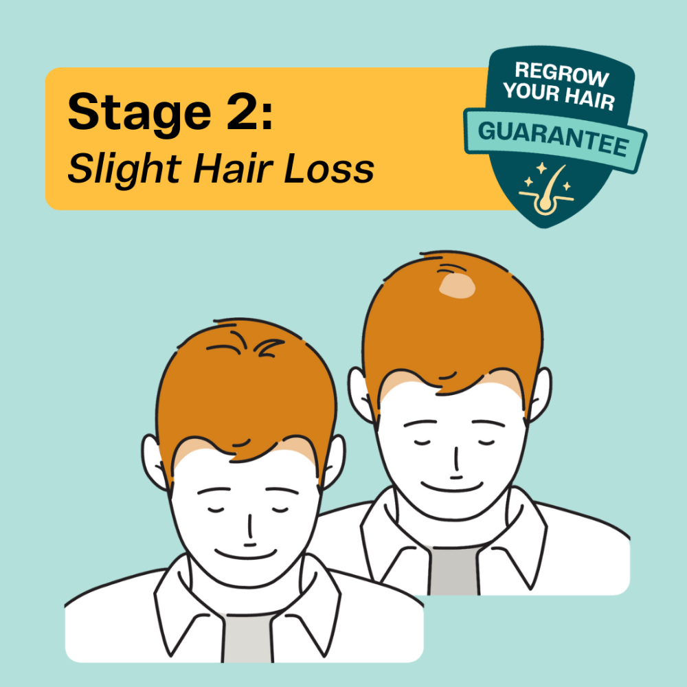 Hair loss solutions for Men at Stage 2 are typically guaranteed