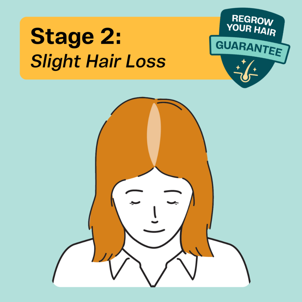 Hair thinning treatments for women at Stage 2