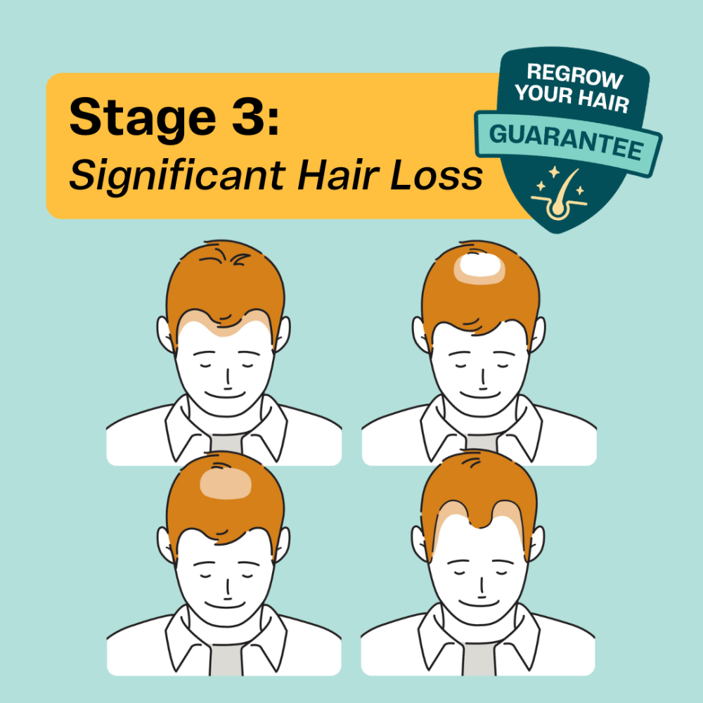 The best hair loss treatments for men at Stage 3 include pharmaceutical, laser and natural therapy