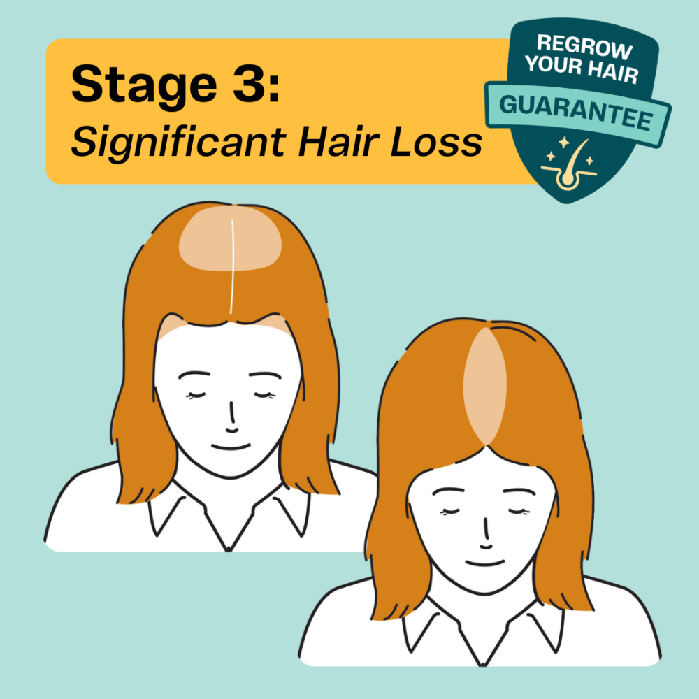 Hair thinning in women at Stage 3