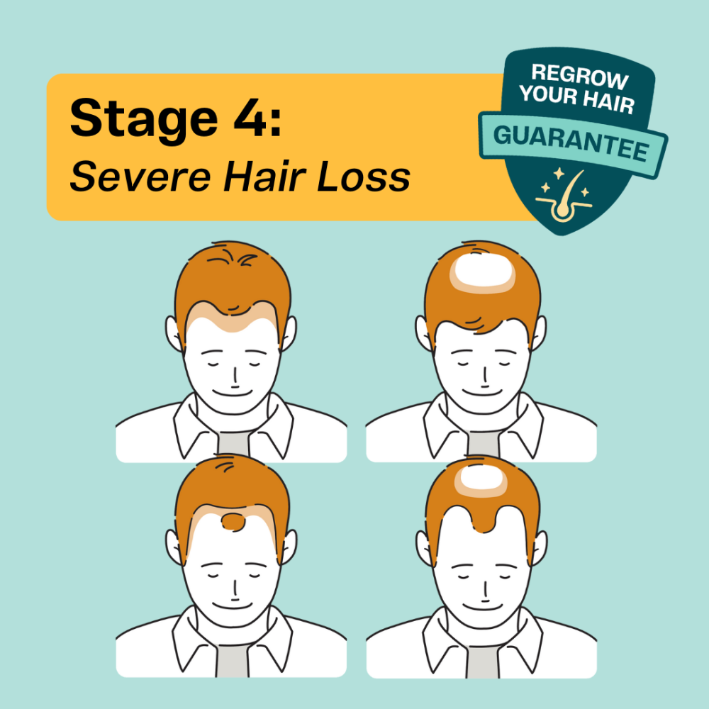 Hair regrowth is usually guaranteed for Stage 4 hair loss