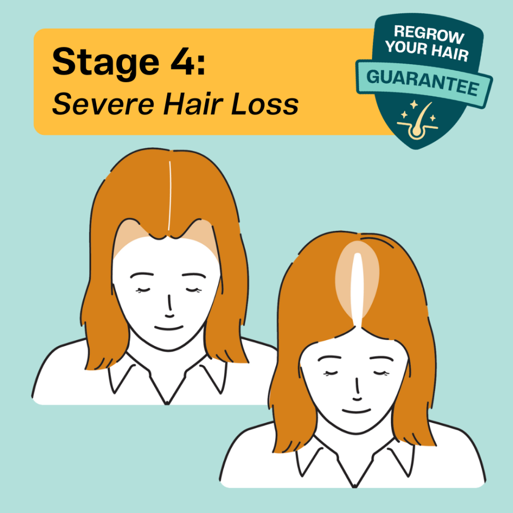 Hair thinning in females at Stage 4