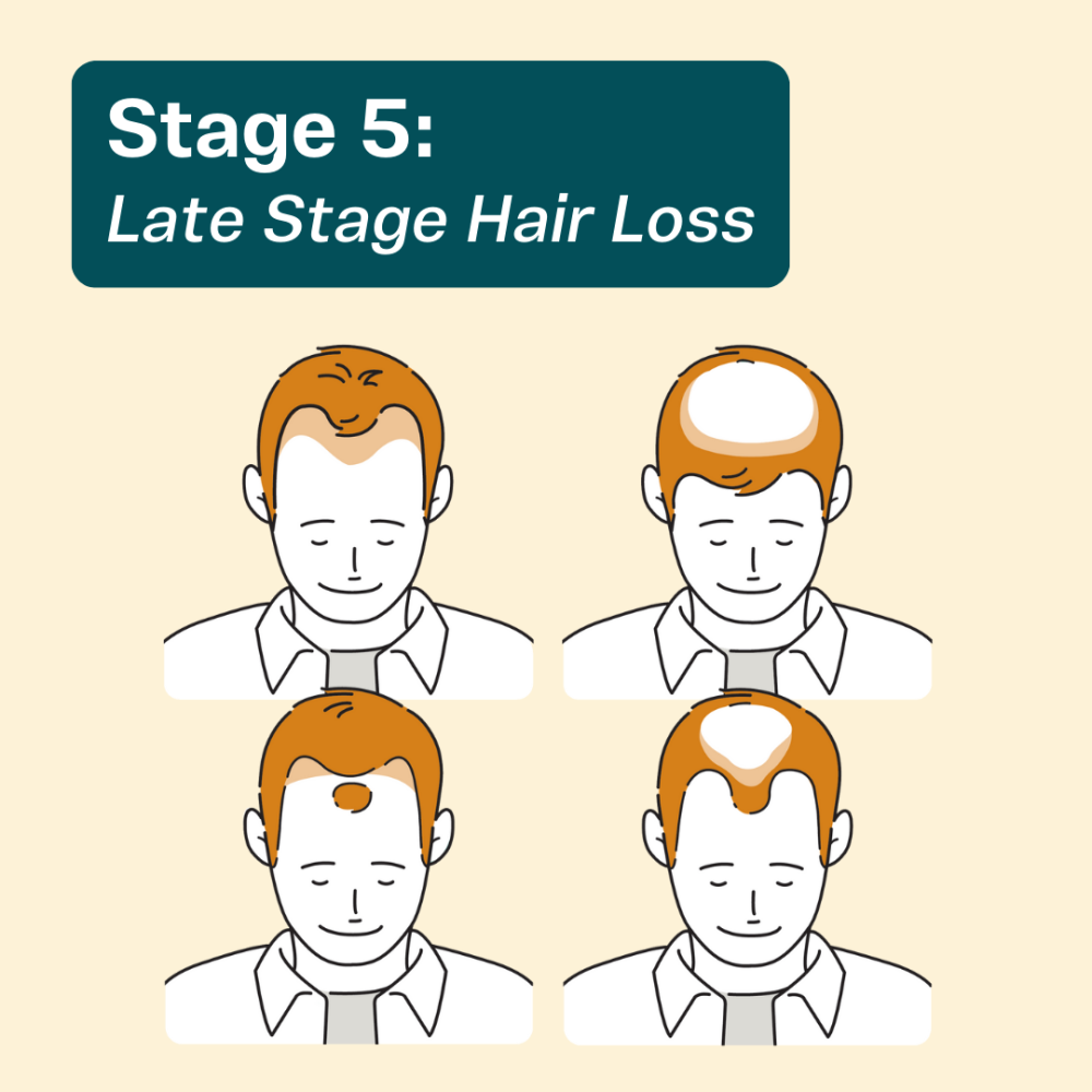 Ashley and Martin hair loss treatments may also be effective in the later stages of balding