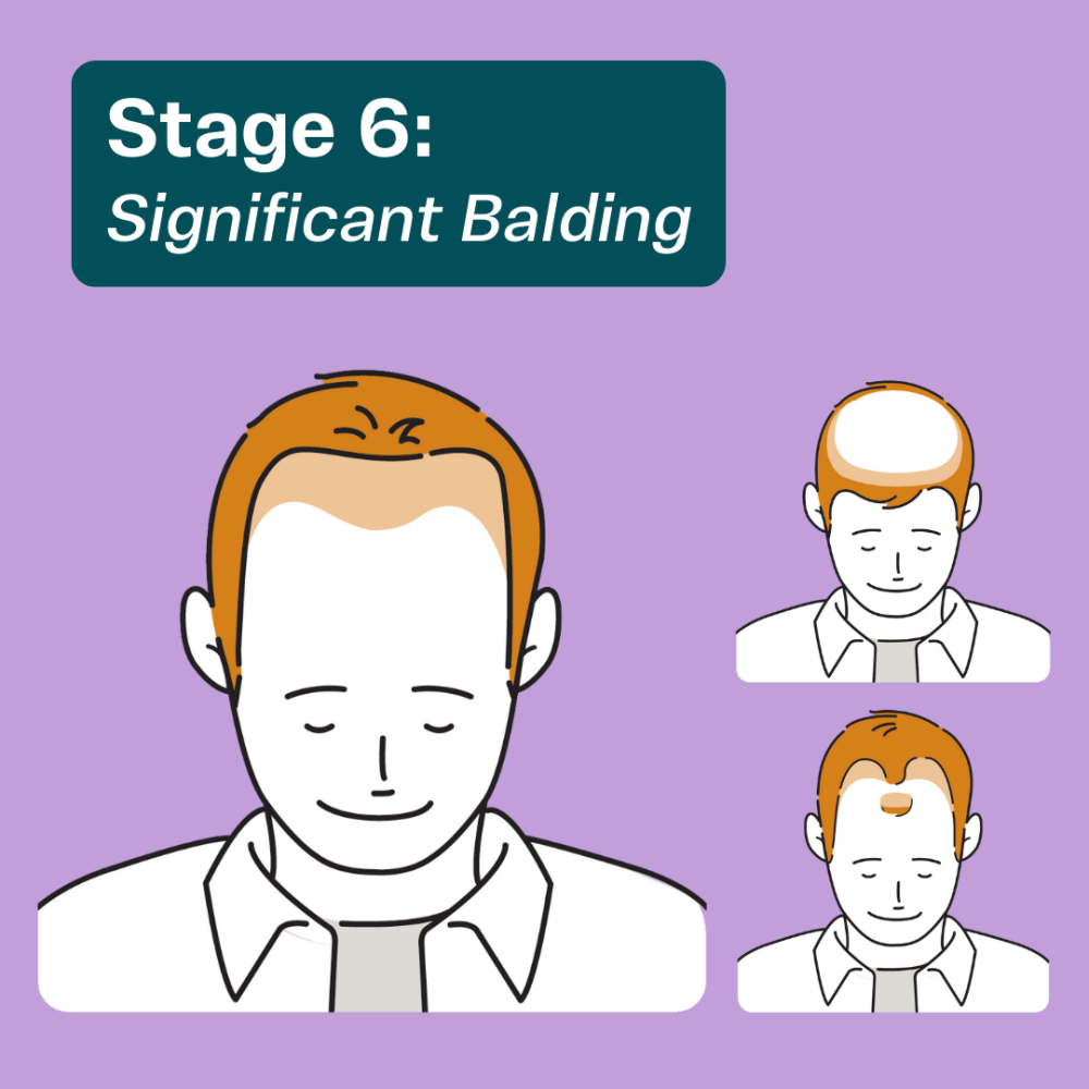 At Stage 6 hair transplant surgery may be the most effective treatment option