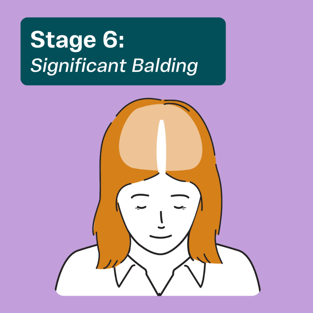 Hair thinning in females at stage 6
