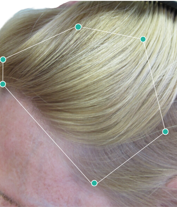 Womens hair loss treatment after