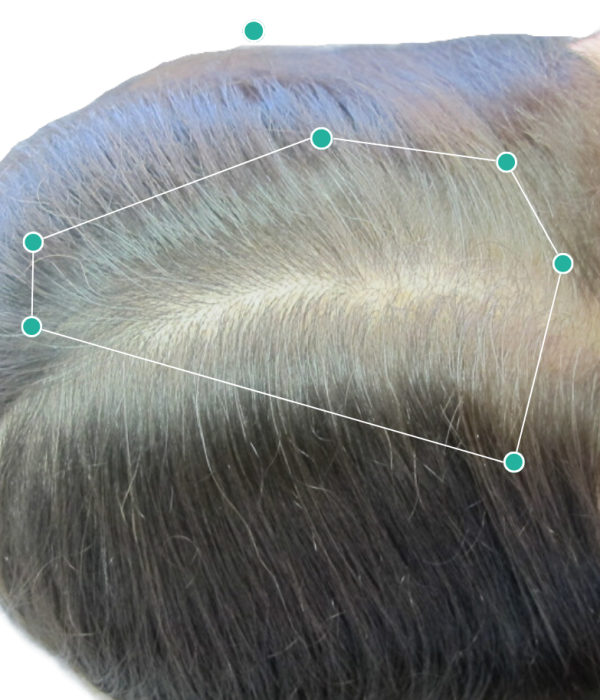 Female recovering from Stage 3 hair loss results