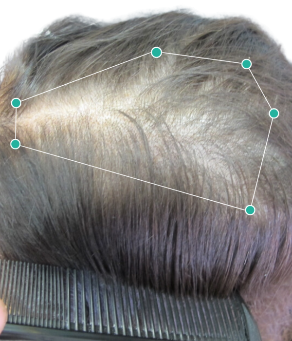 Stage 3 female hair thinning before treatment