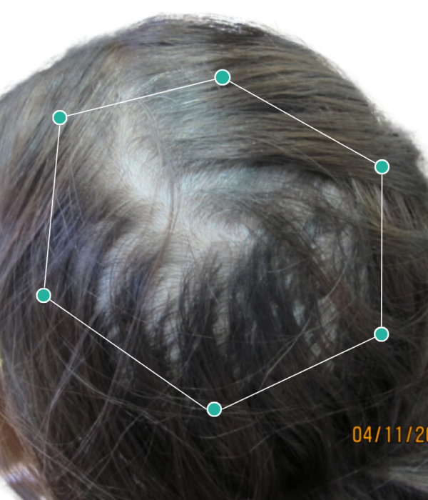 Woman with Stage 4 balding on the crown before treatment