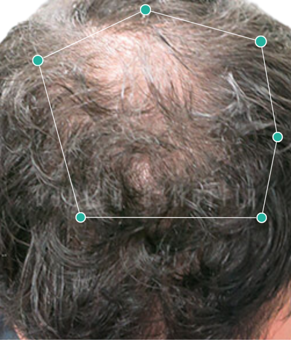 Hair loss after dandruff