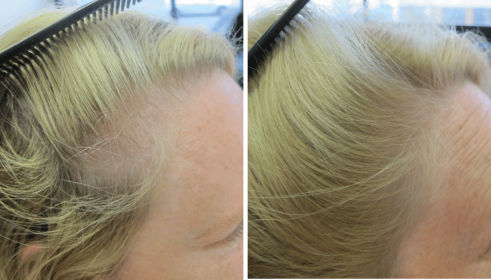 Receding hair treatment for women