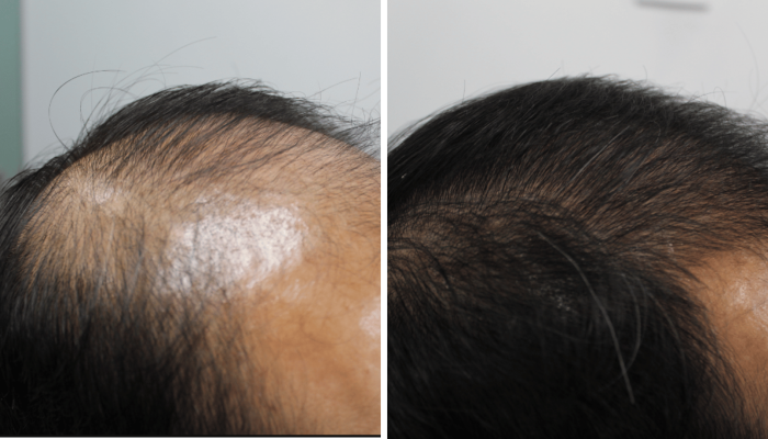 Successful hair regrowth without a hair transplant surgery