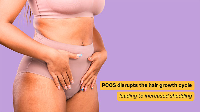 PCOS hair loss in women