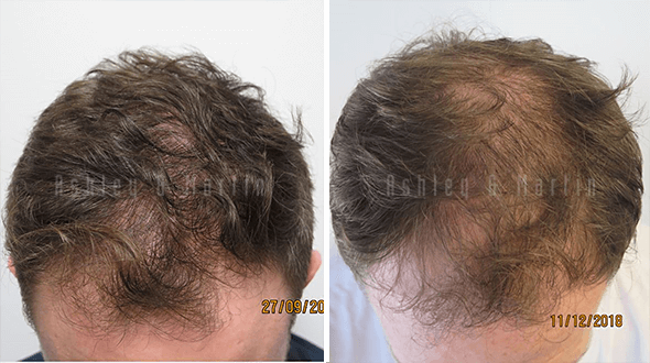 hair loss cure results using finasteride