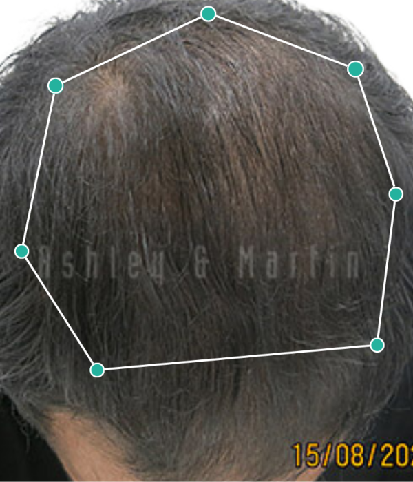 Hair loss treatment cures steroid related hair loss after