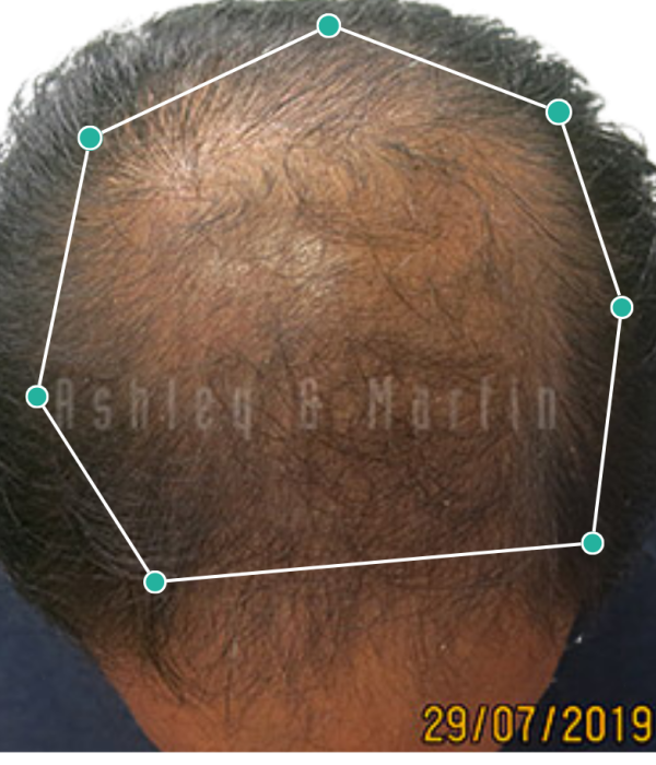Hair loss treatment for steroid related hair loss before image