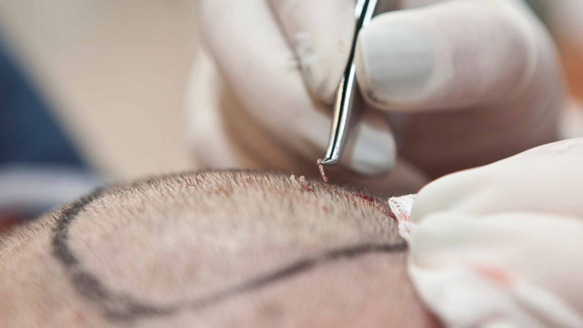 Hair Transplant Replacement Surgery Trends: Read This First Image