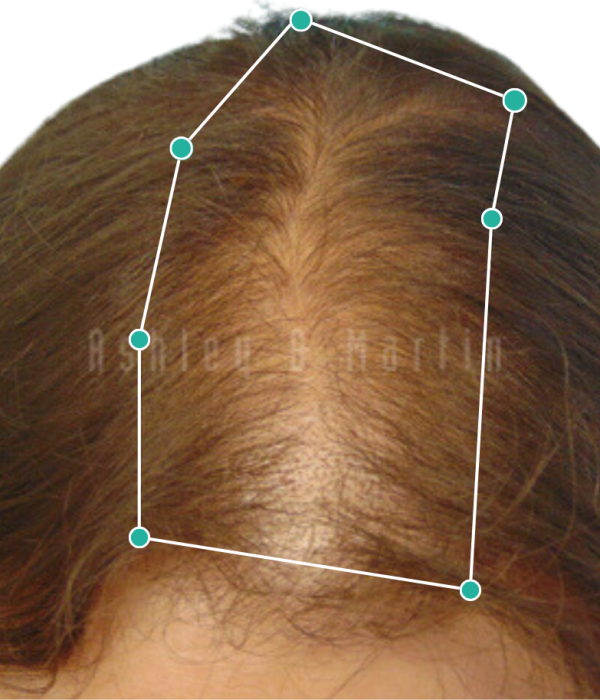 Womens hair thinning before hair loss treatment
