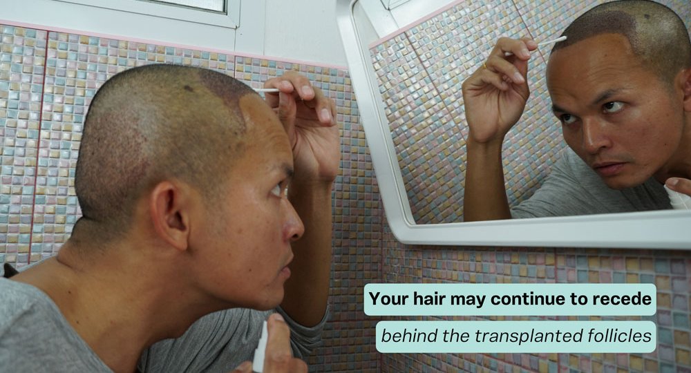 Cheap hair transplants can cause problems